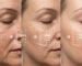 laser resurfacing progressional treatment