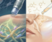 microneedling vs chemical peels